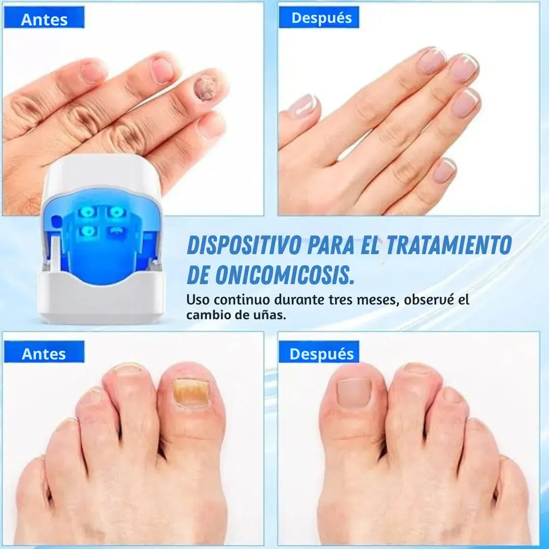 Removedor Profesional de Hongos dolccia® con Luz LED Terapéutica